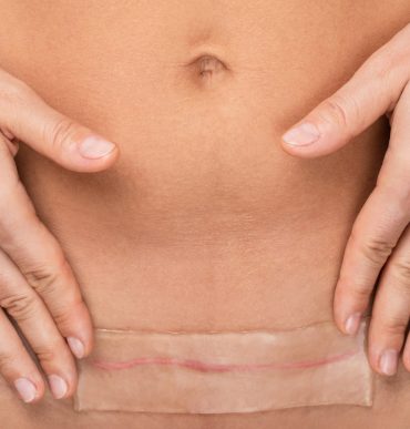 Close-up of a woman’s lower abdomen showing a healed C-section scar covered with a transparent silicone scar sheet, with hands gently resting on either side.
