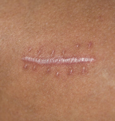 Post-operative scar showing smooth, pale healing tissue.