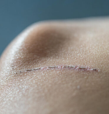 Close up of a stitched incision on the upper shoulder