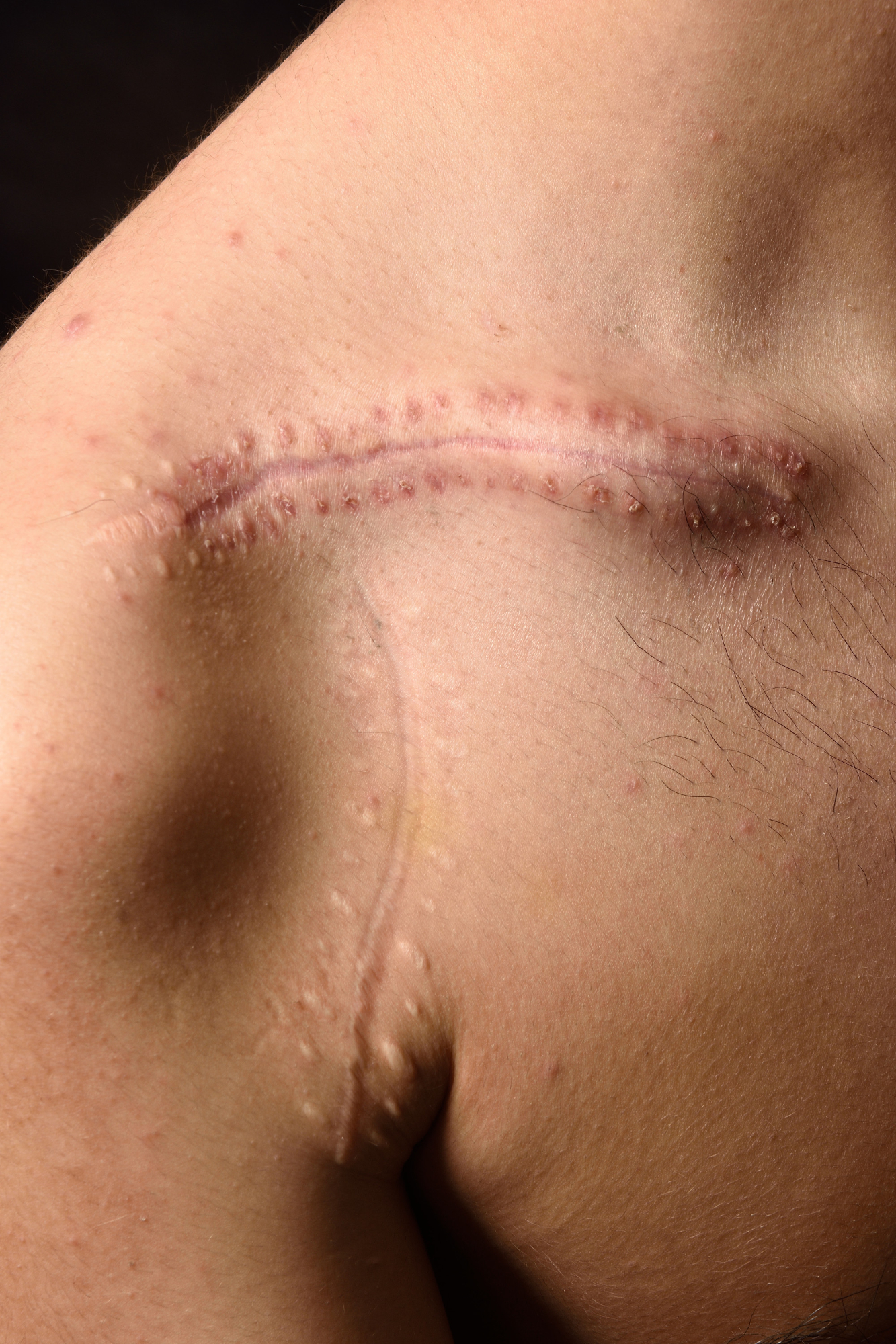 Close-up of a raised and healing surgical scar on the shoulder area, showing signs of keloid or hypertrophic scarring with textured skin.