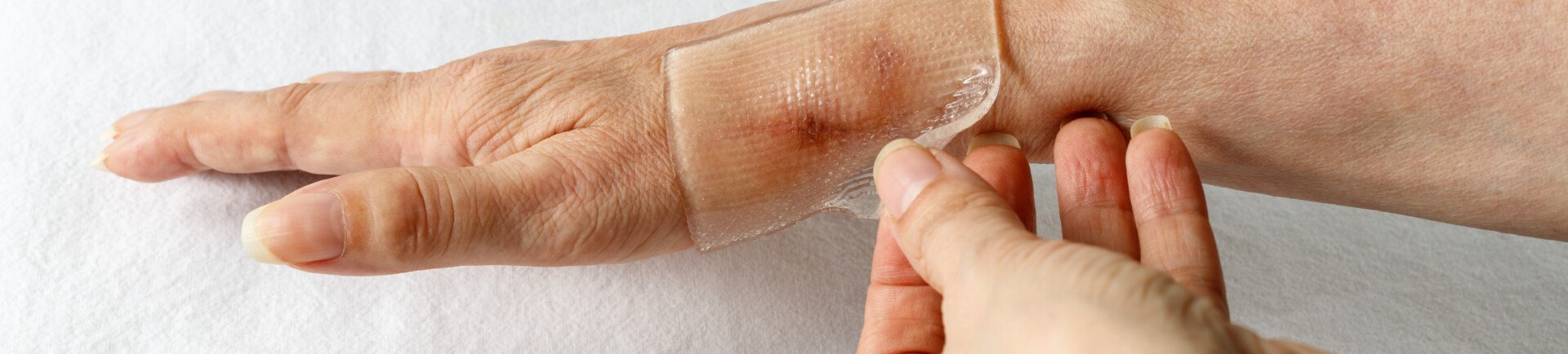 Silicone Product on scar on a woman's hand