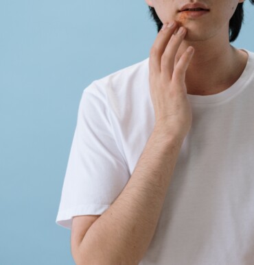 Patient with eczema near the mouth