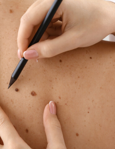 Dermatologist applying marks onto patient's skin before moles removal, closeup