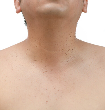 Closed up the skin tags or Seborrheic Keratosis on neck man isolated on white background.Health care concept