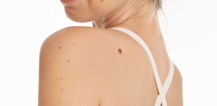 Woman with birthmark on her back
