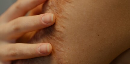 woman touching her scar on her arm