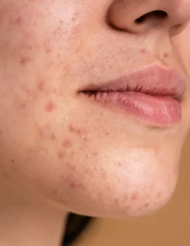 woman's face covered by acne scars
