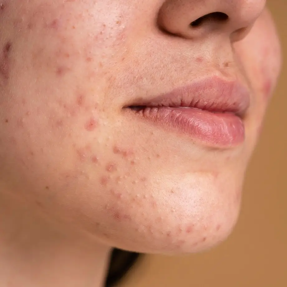 woman's face covered by acne scars