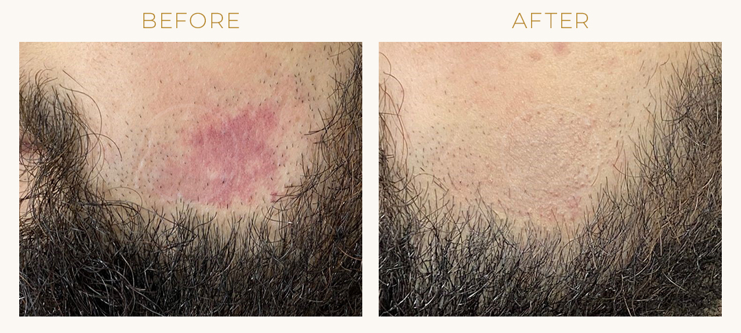 Medical tattooing before-after on skin