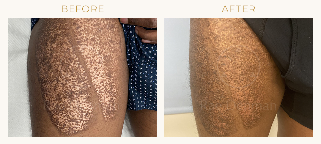 Medical tattooing before-after on man's leg