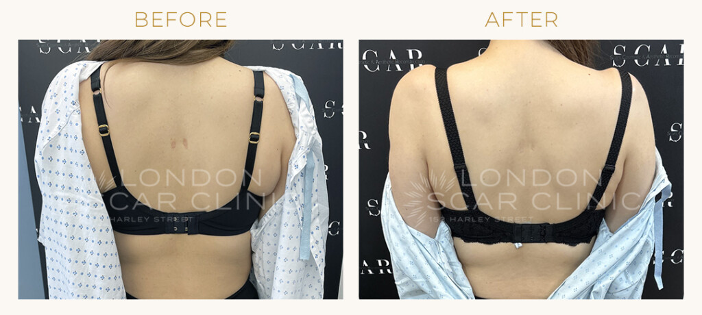 laser treatment before and after on a woman's back