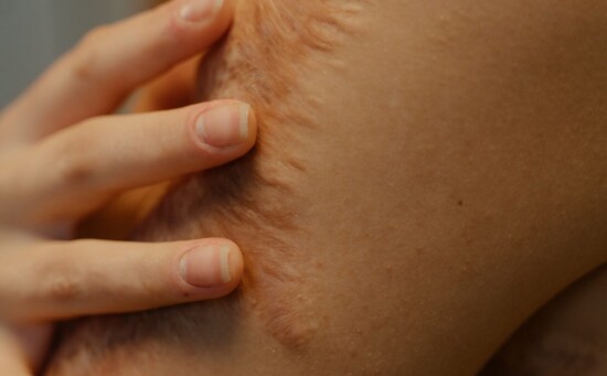 woman touching scar on her arm