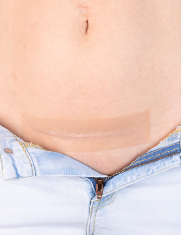 Woman in jeans with visable birth scar