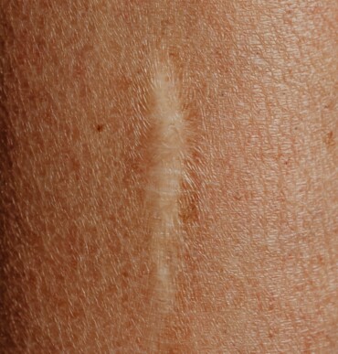 old scar on skin