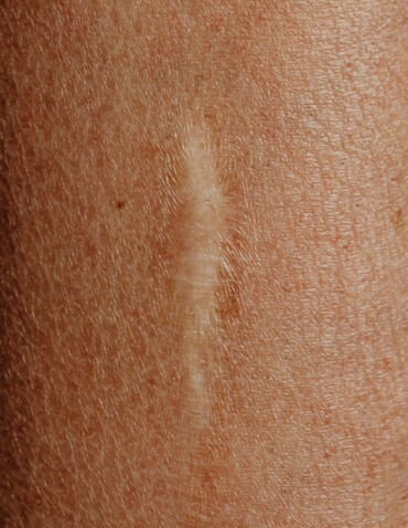 old scar on skin