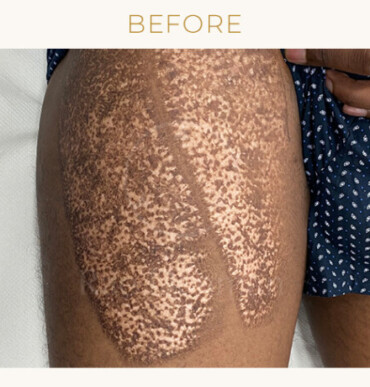 medical tattoo before on leg scars