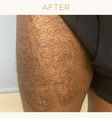 medical tattoo after on leg scars