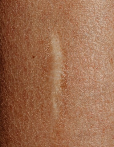 close-up of a scar