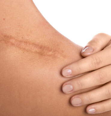 Close up of female shoulder with a scar