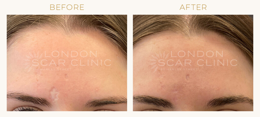 Scar Excision before and after
