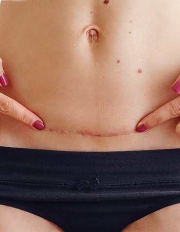 Cesarean Scar Cesarean Scar Pregnancy With Professor Ilan Timor MD