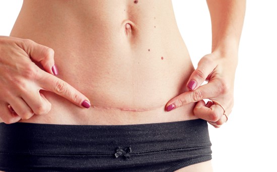 Closeup of woman belly with a scar from a cesarean section