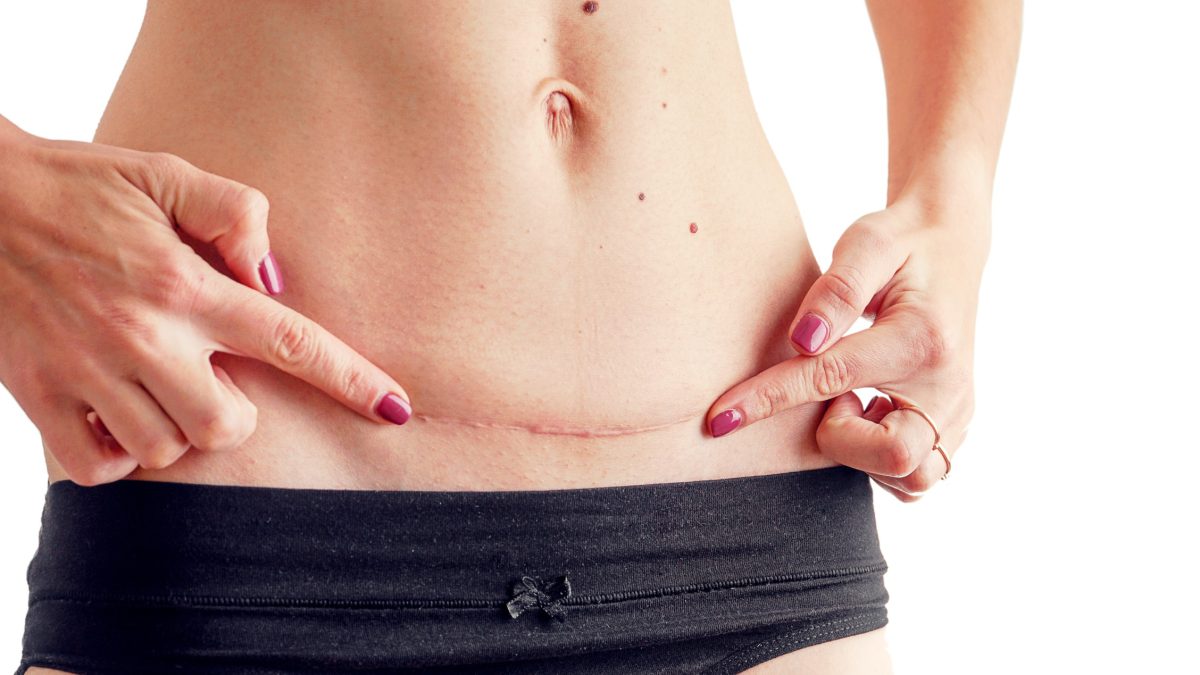 How Scar Removal Dubai Supports Skin Confidence Growth