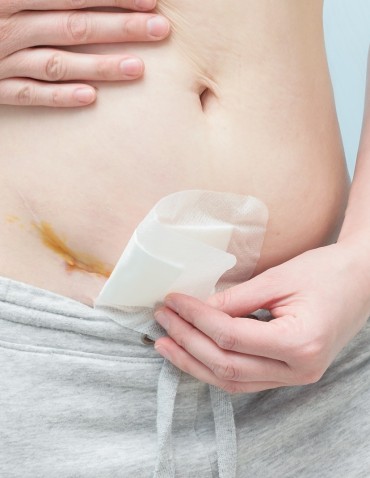 Closeup of woman belly with a scar from a cesarean section with a medical bandage