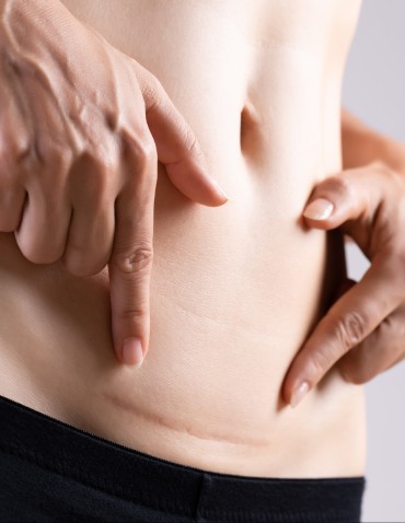 Closeup of woman showing on her belly dark scar from a cesarean