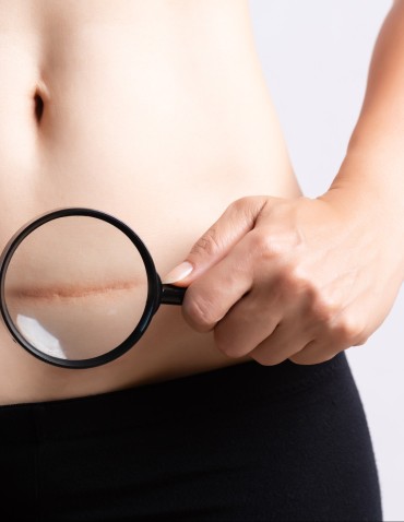 Closeup of woman showing on her belly dark scar from a cesarean
