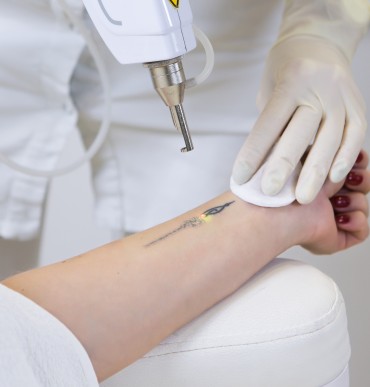 Cosmetologist doing laser tattoo removal from woman hand