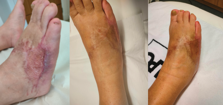 before and after lpg endermologie treatment