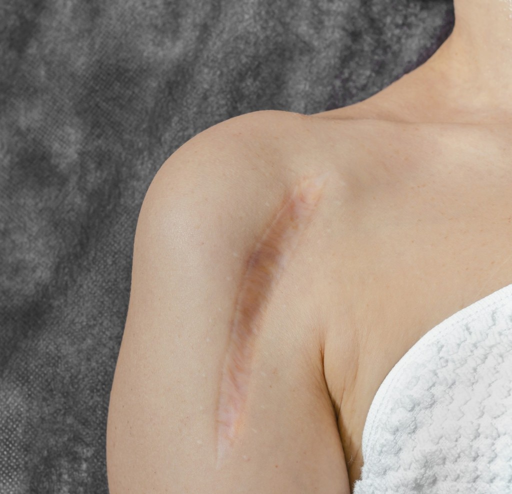 Vertical keloid scar after bone surgery on a woman’s shoulder