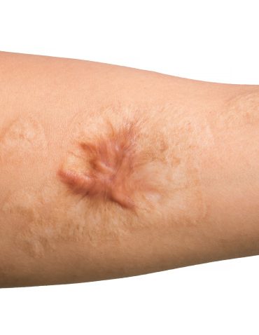 keloid scar on arm