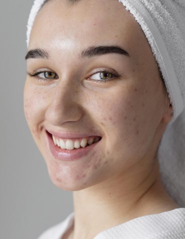 Close-up of a young woman with a radiant smile, fresh skin with mild acne and scars, wrapped in a white towel. Her natural glow suggests post-treatment care, possibly related to scar revision or skincare therapy.