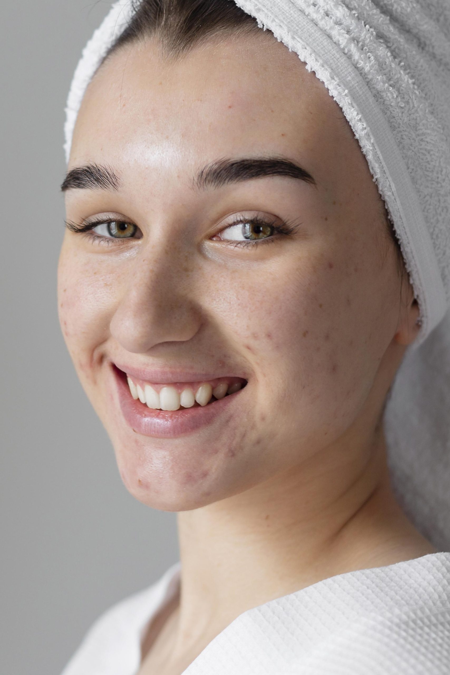 Close-up of a young woman with a radiant smile, fresh skin with mild acne and scars, wrapped in a white towel. Her natural glow suggests post-treatment care, possibly related to scar revision or skincare therapy.