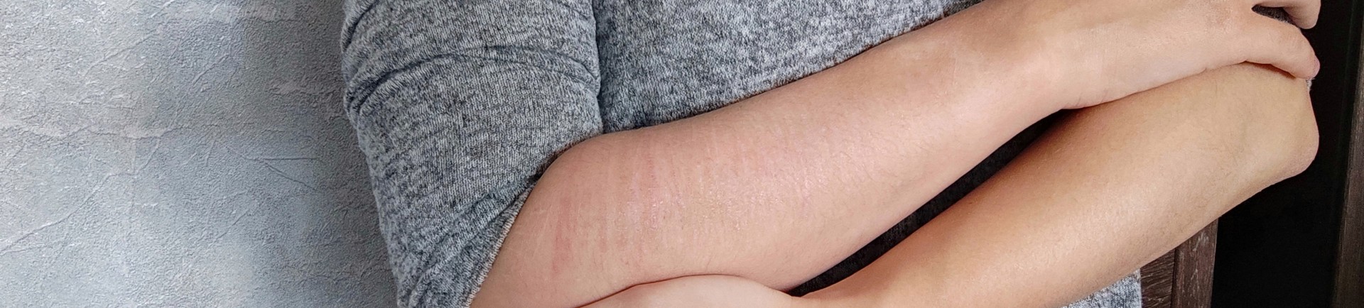 woman with self-harm scars wraps her arms around herself