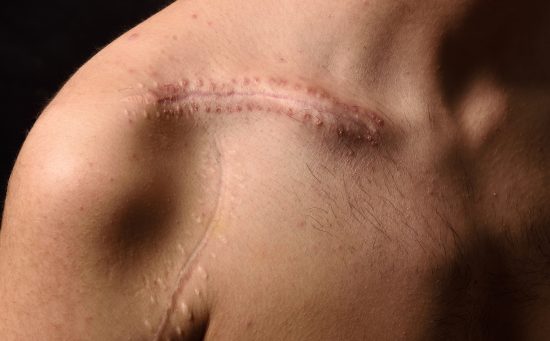 Close-up image of a healing scar across the clavicle and shoulder area, showing raised and textured skin consistent with post-surgical recovery.