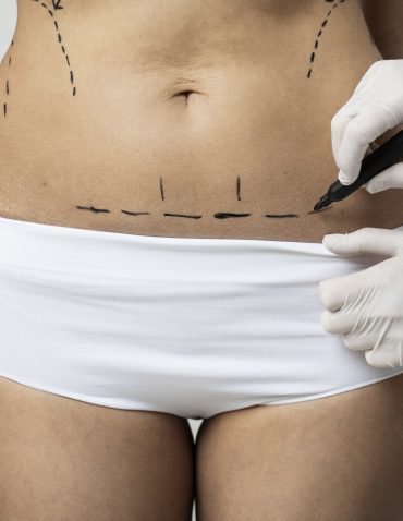 front view of a woman with marker traces on her skin before skin grafting
