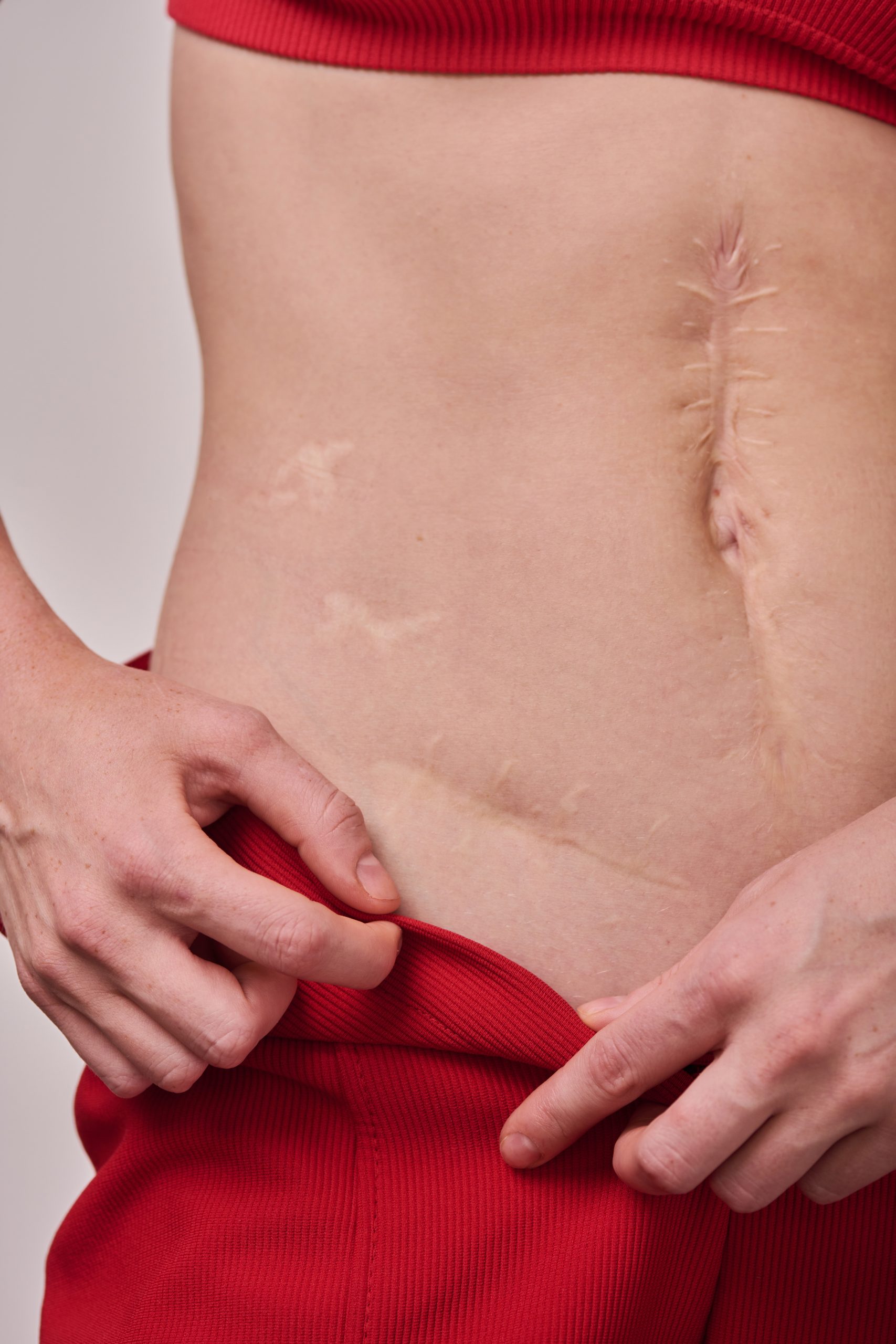 Close-up of young body positive woman showing surgical scar on her body