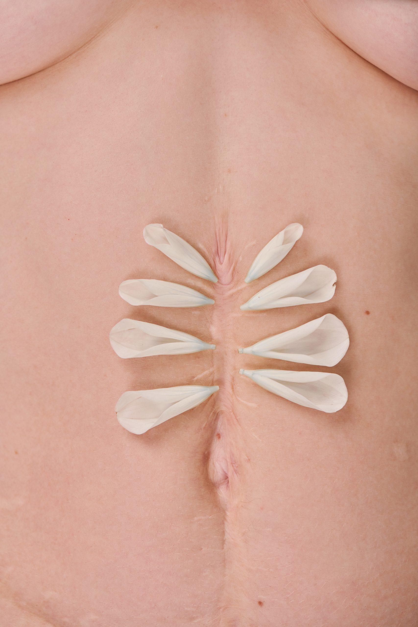 Close-up of slim female body with surgical scar and flower petals around it