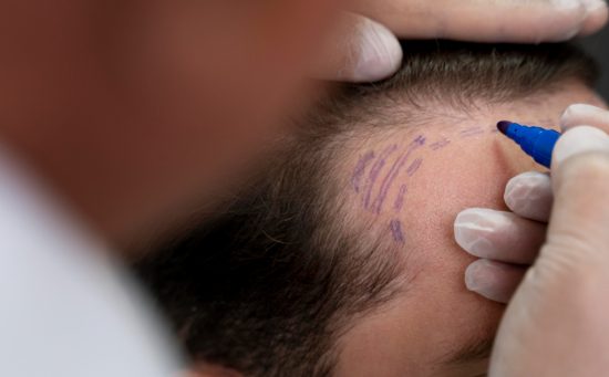 Close-up of a doctor drawing hairline markings on a male patient's scalp with a blue surgical pen before a hair transplant
