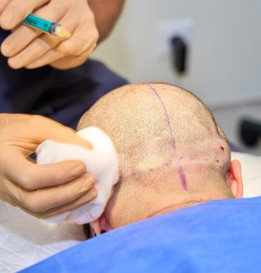 Close-up of a marked scalp during a hair transplant procedure with a surgeon holding a syringe and gauze