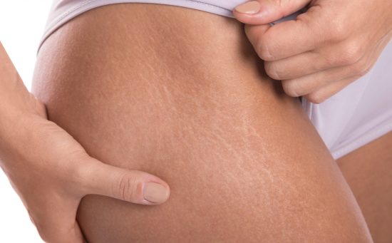 Close-up of stretch marks on a woman's thigh and hip area