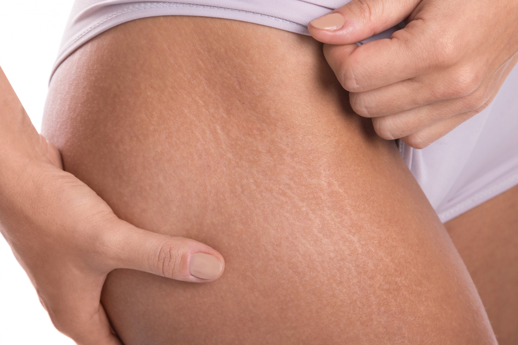 Close-up of stretch marks on a woman's thigh and hip area
