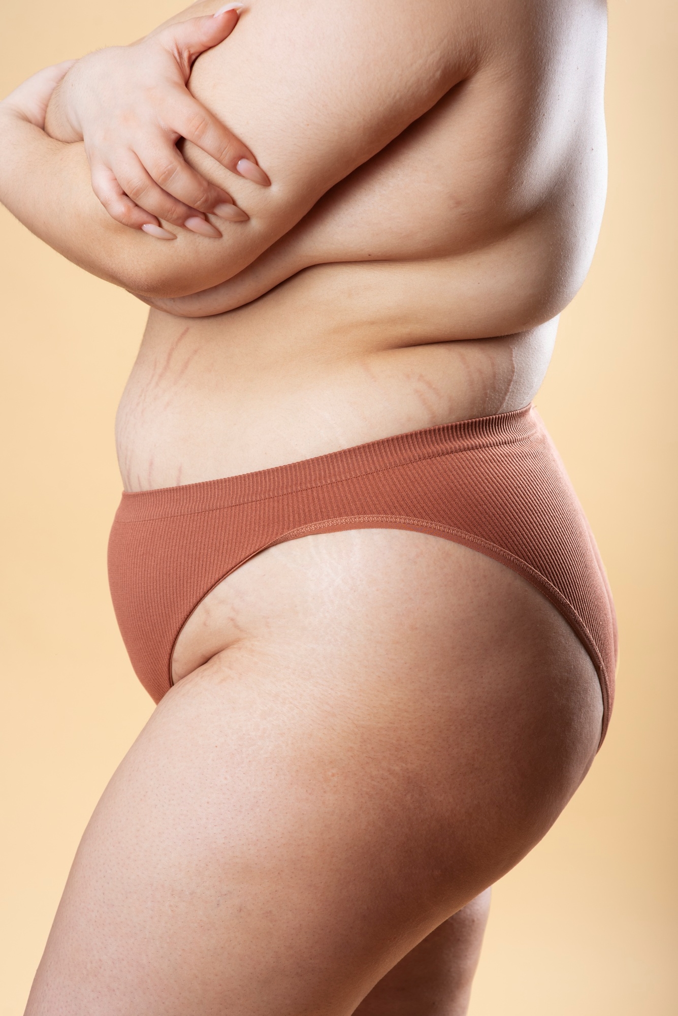 Side view of a woman's torso showing stretch marks on the stomach and hip against a beige background